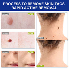 Skin Tag Remover Patches (144 patches) | Medicated Patch for Skin Tags, Moles, Warts, Acne Scars, and Corns