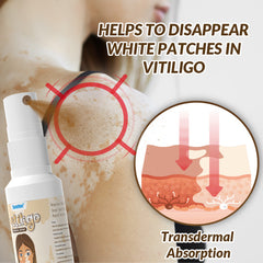 Vitiligo Removal Spray