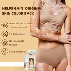 Vitiligo Removal Spray