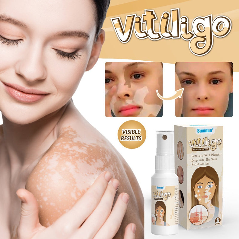 Vitiligo Removal Spray