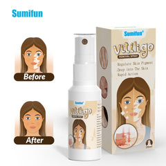 Vitiligo Removal Spray | Topical Spray for Skin Pigmentation and White Patches