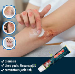 Itching Relief Cream | Topical Ointment for Psoriasis, Dermatitis, Eczema, Tinea, and Folliculitis