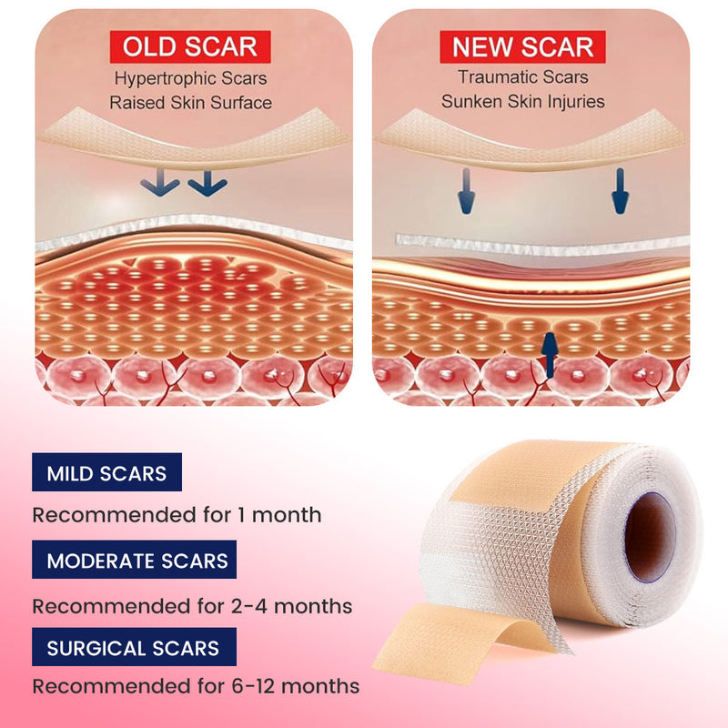 Silicone Scar Sheets (4*150cm)