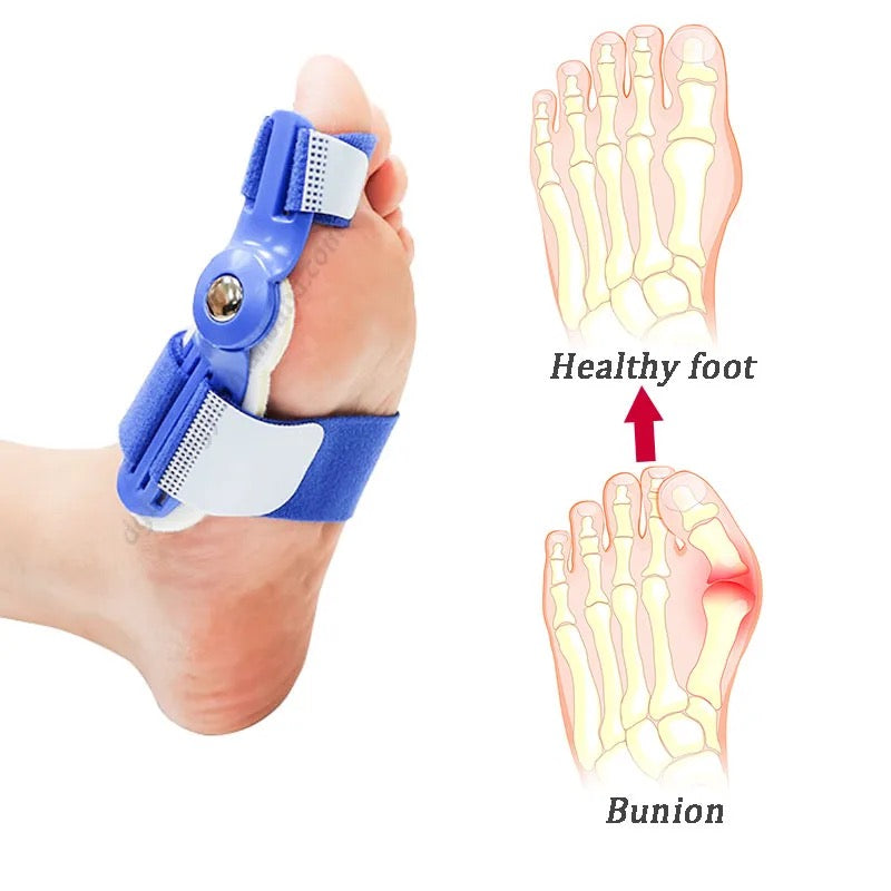 Bunion Corrector | Hallus Valgus Corrector | Orthopedic Bunion Splint