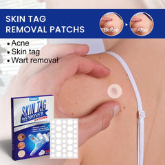 Skin Tag Remover Patches (144 patches) | Medicated Patch for Skin Tags, Moles, Warts, Acne Scars, and Corns