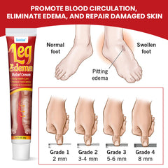 Leg Edema Relief Cream