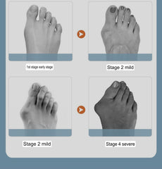 Big Toe Bunion Corrector | Hallus Valgus Corrector