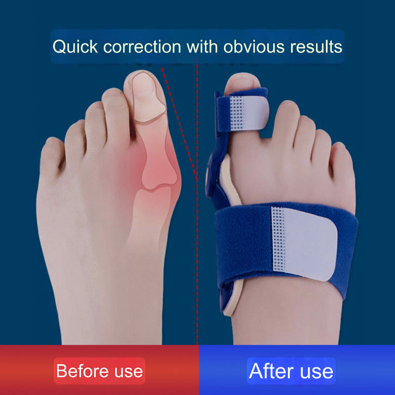 Big Toe Bunion Corrector | Hallus Valgus Corrector