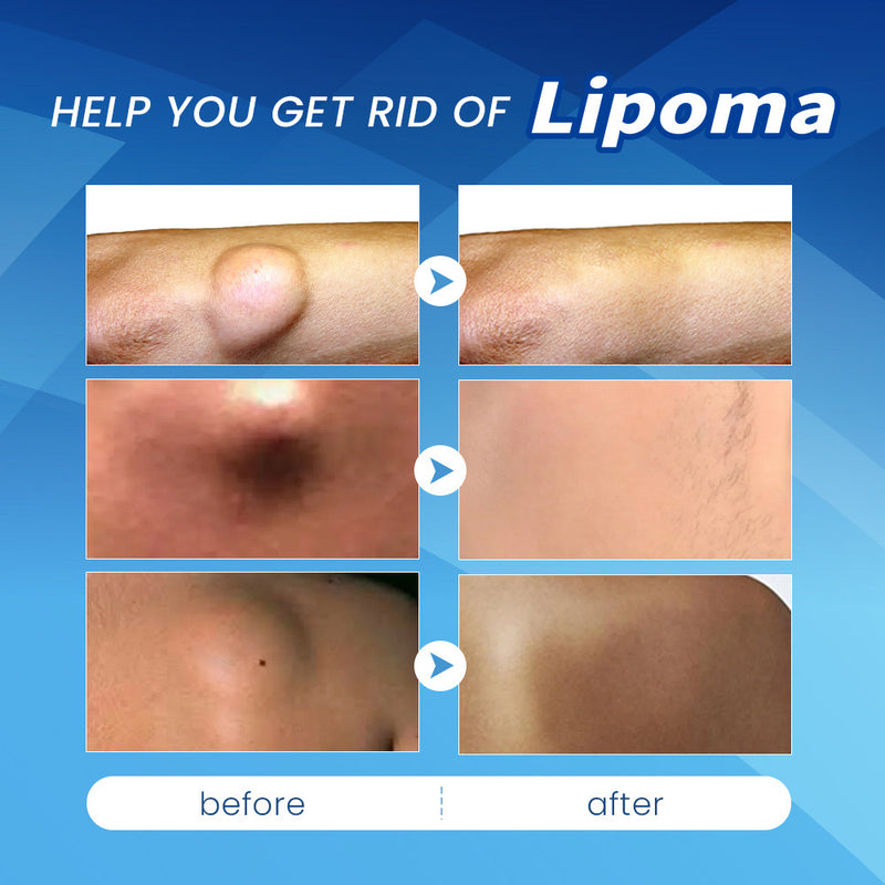 Lipoma Relief Patch