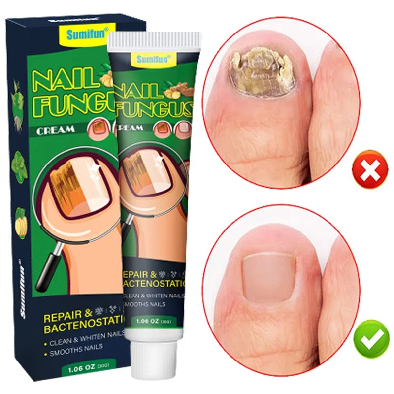Nail Fungus Treatment and Prevention