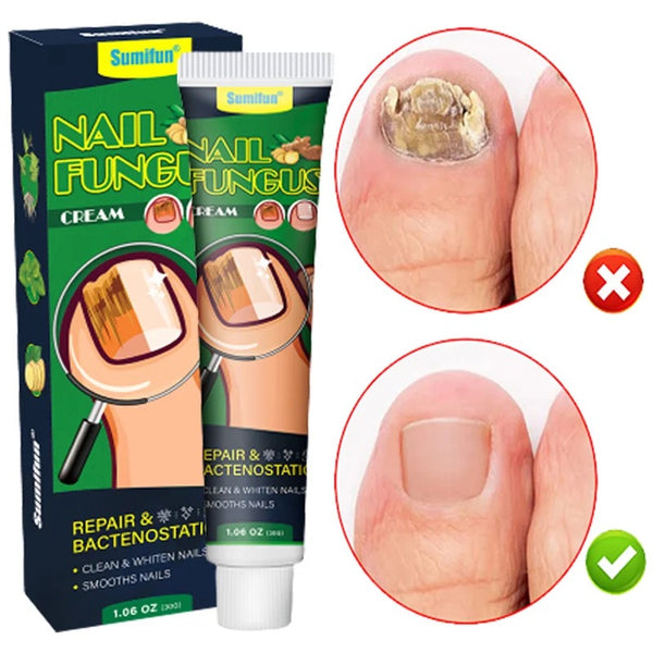 What Are SkinBiotix Toe Fungus Remover & How #1 Anti-Fungal Formula Works!  | by SkinBiotix Toe Fungus Remover Official | Medium