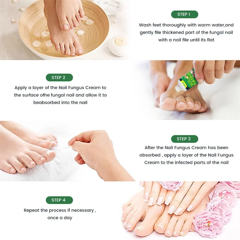 Qian Herbal Foot Cream Nail Fungus Removal Cream Effective Anti Fungal  Infection Onychomycosis Treatment Toe Fungus Repair Feet Care | Fruugo DK