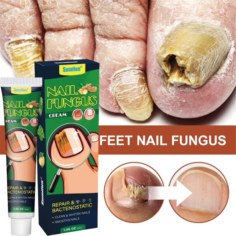 nail fungus cream/ nail fungus treatment/ nail strengthening oil/ strong  nail glue/ nail strong oil/
