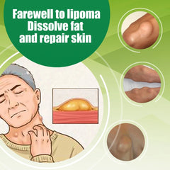 Lipoma Spray | Topical Spray for Skin Lump, Benign Lipoma and Tumor