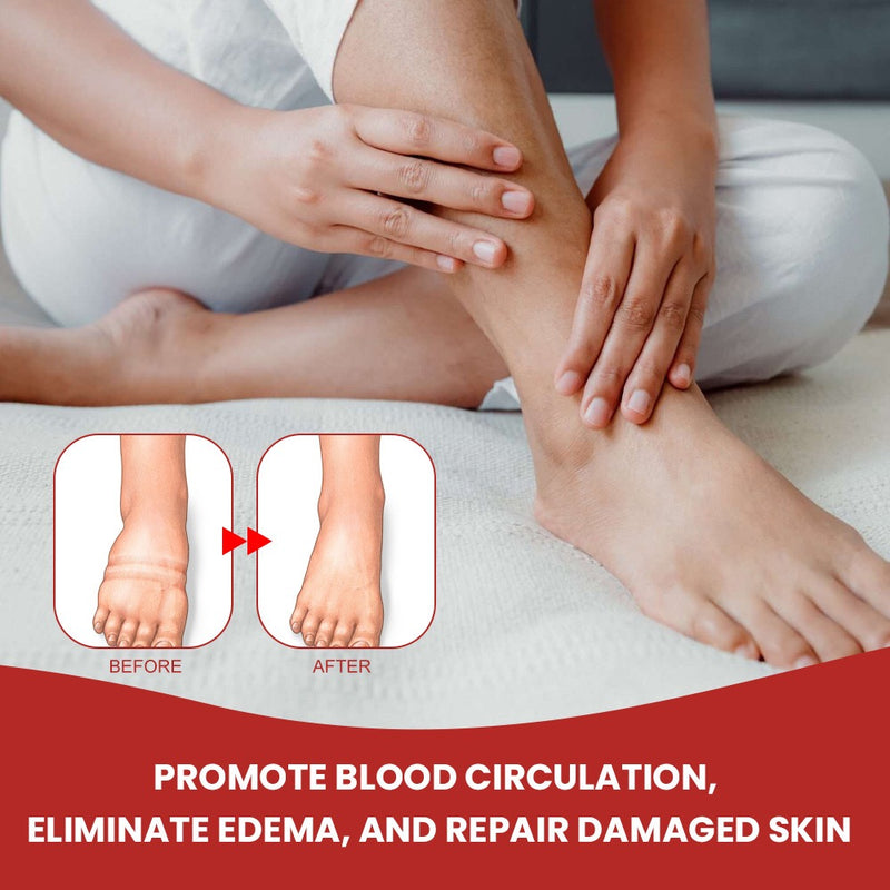 Anti-Edema Spray | Topical Spray for Foot Edema