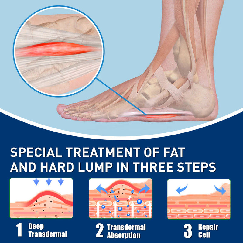 Fibroma Cream | Topical Cream for Plantar Fibroma, Cervical Fibromatosis, Lipoma, and Breast Fibroid