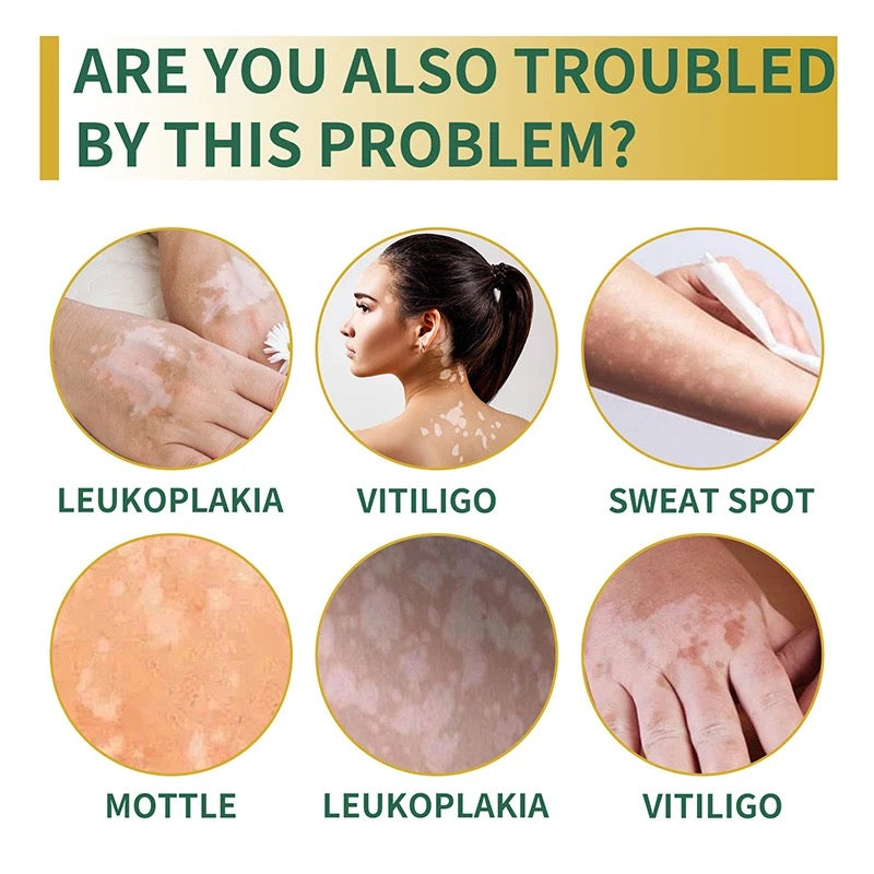 Vitiligo Relief Cream | Topical Ointment for White Spots, Leukoplakia, Sweat Spots, Piebald, Mottle, and Vitiligo