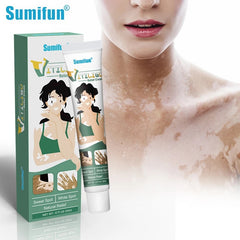Vitiligo Relief Cream | Topical Ointment for White Spots, Leukoplakia, Sweat Spots, Piebald, Mottle, and Vitiligo