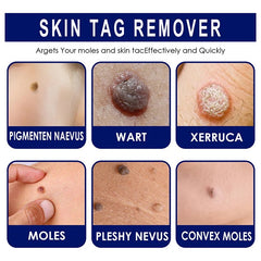 Skin Tag Removal Cream