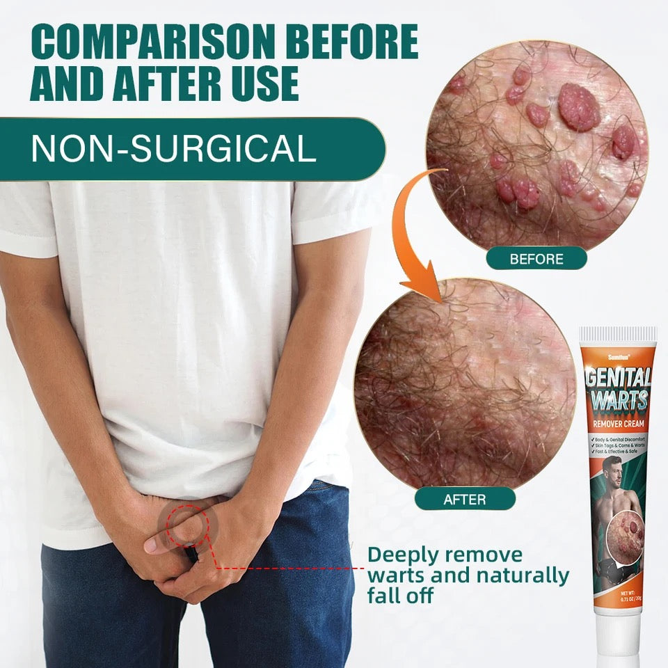 Genital Warts Remover Cream Ginax Store genital-warts-remover-cream-ginax-store