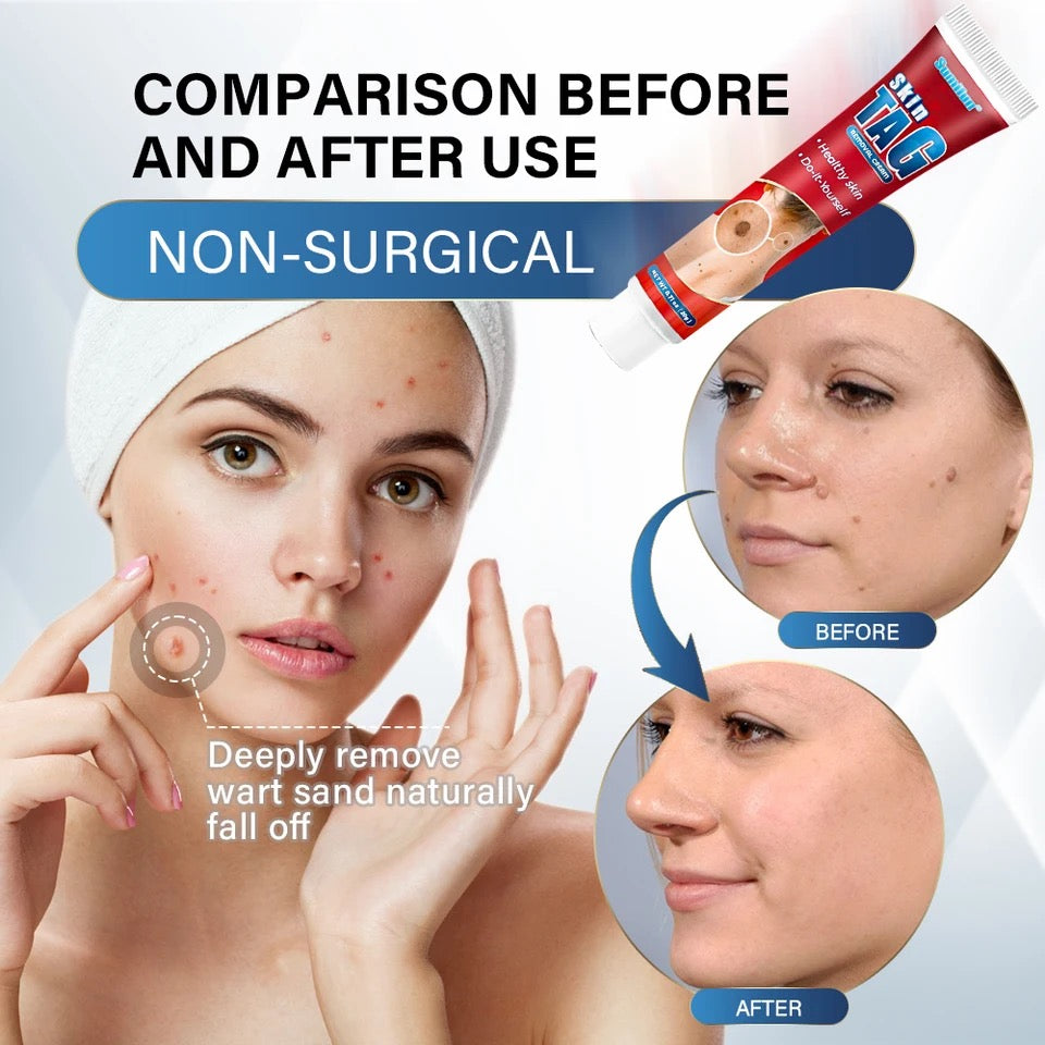 Skin tag removal cream topical crean for moles skin tags acne scar