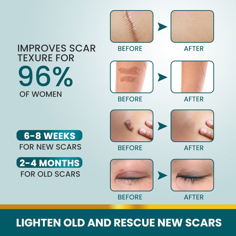 Silicone Scar Cream for Old and New Scars