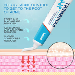 Expigment Cream (4% hydroquinone) | Topical Cream for Dark Spots, Acne Spots, Sun Spots, Age Spots, and Melasma