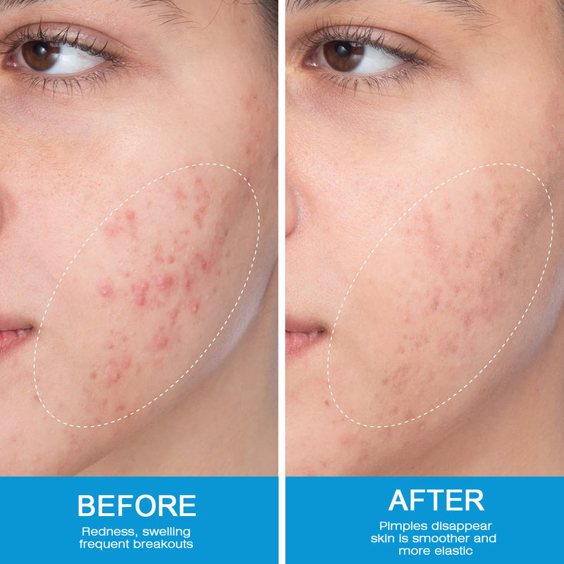 Expigment Cream (4% hydroquinone) | Topical Cream for Dark Spots, Acne Spots, Sun Spots, Age Spots, and Melasma
