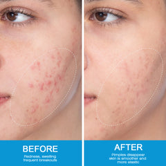 Expigment Cream (4% hydroquinone) | Topical Cream for Dark Spots, Acne Spots, Sun Spots, Age Spots, and Melasma