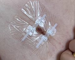 Zipper Strip Skin Closure for Wound Dressing (2 pieces)