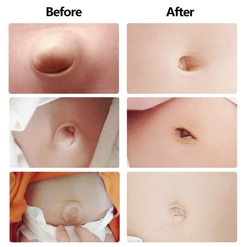 Infantile Umbilical Hernia Belt (0-1 year, 2 pieces, 6cm×45cm)