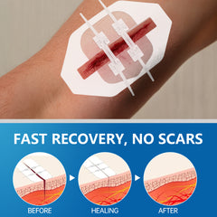 Zipper Strip Skin Closure for Wound Dressing (2 pieces)