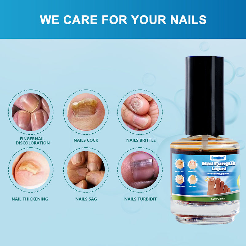 Nail Fungus Liquid (15ml) | Topical Ointment for Ingrown Nails, Brittle Nails, Thick Nails, Sinking Nails, and Discolored Nails