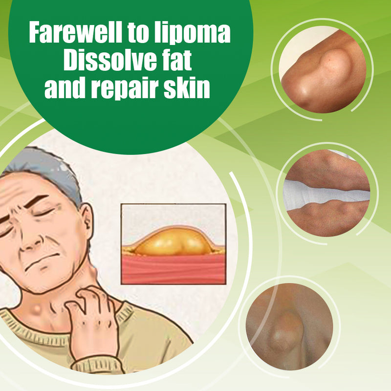 Lipoma Roll-On | Topical Ointment for Lipolysis, Fat Lump, and Nodular Discomfort
