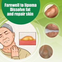 Lipoma Roll-On | Topical Ointment for Lipolysis, Fat Lump, and Nodular Discomfort