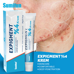Expigment Cream (4% hydroquinone) | Topical Cream for Dark Spots, Acne Spots, Sun Spots, Age Spots, and Melasma