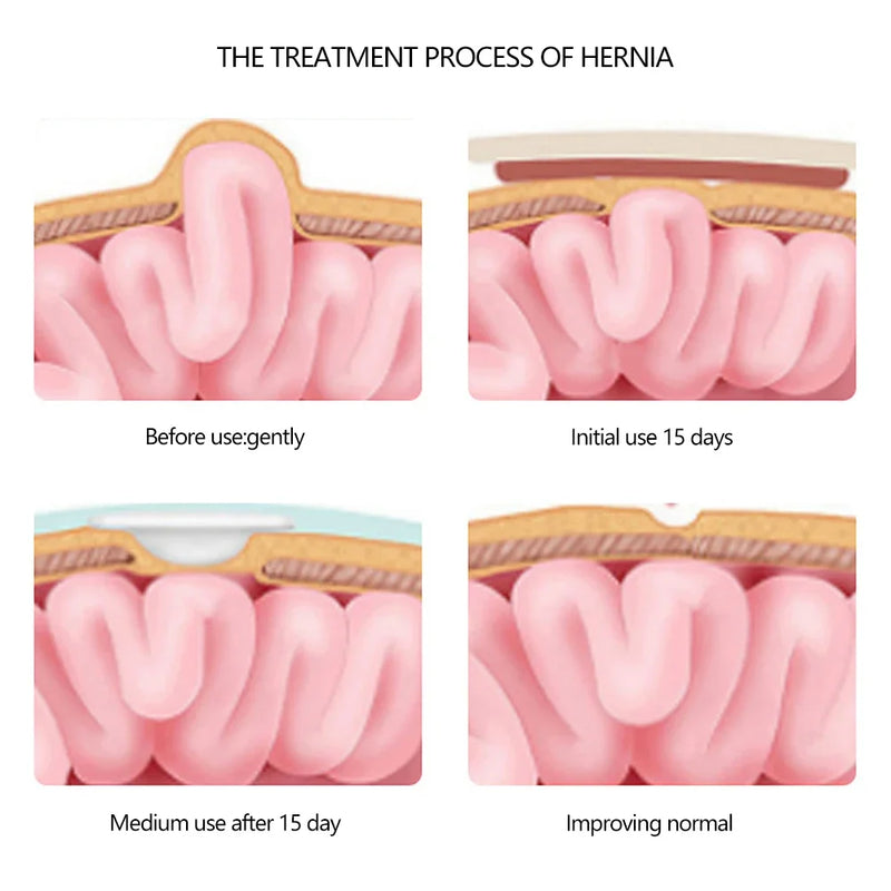 Infantile Umbilical Hernia Belt (0-1 year, 2 pieces, 6cm×45cm)