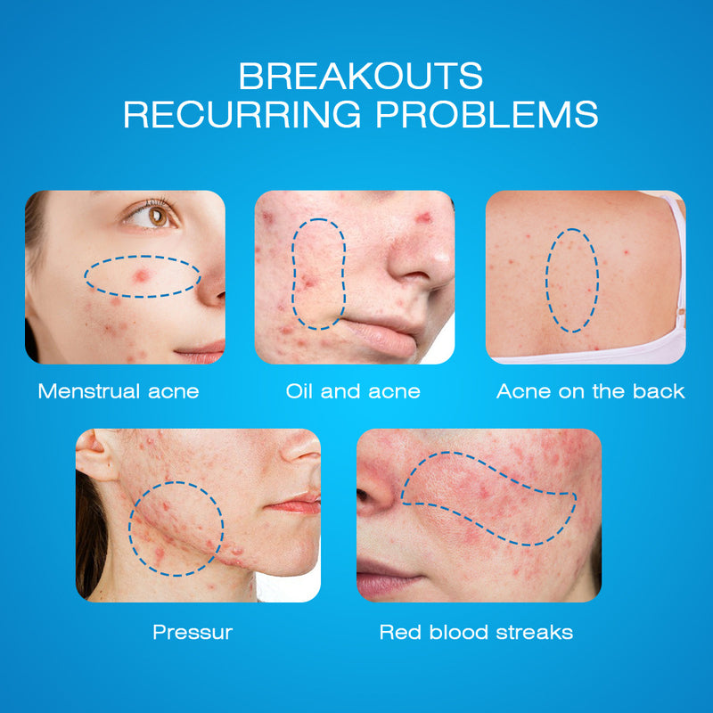 Expigment Cream (4% hydroquinone) | Topical Cream for Dark Spots, Acne Spots, Sun Spots, Age Spots, and Melasma