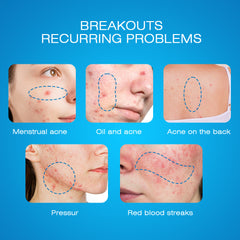 Expigment Cream (4% hydroquinone) | Topical Cream for Dark Spots, Acne Spots, Sun Spots, Age Spots, and Melasma