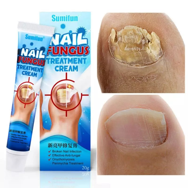Is this toenail fungus? Find out here. – Eltham Foot Clinic