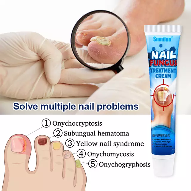 Nail Fungus Treatment Cream | Herbal Ointment for Fungal and Discolorated Nails