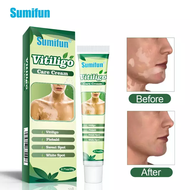 Vitiligo Care Cream | Topical Ointment for White Spots, Piebald, and Vitiligo