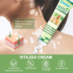 Vitiligo Care Cream | Topical Ointment for White Spots, Piebald, and Vitiligo
