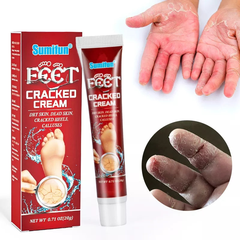 Cracked Hands and Feet Cream | Skin Ointment for Cracked Heels, Dry Skin and Dead Skin
