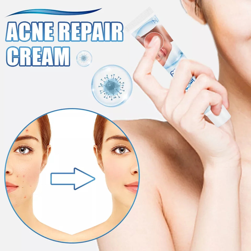 Acne Repair Cream | Herbal Ointment for Pimples, Acne Marks, Postules, and Blackheads