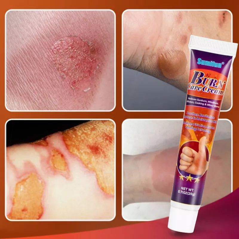Burn Care Cream | Herbal Cream for Burns, Scalds and Blisters