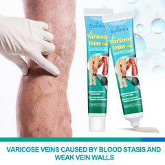 Varicose Veins Cream
