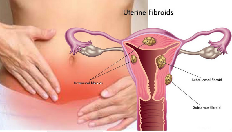 Fibroid Tea | Dietary Supplement for Womb Cleansing, Shrinking Fibroids, and Boosting Fertility