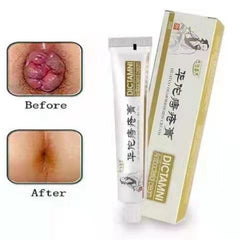 Hemorrhoid Cream | For Pile, Anal Fissure and Proplapse